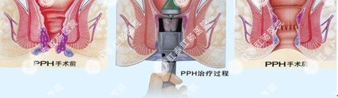 肛肠吻合器手术过程示意图