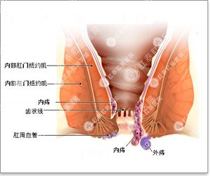 外痔疮的更佳治疗方法？