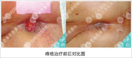 痔疮术前术后对比图